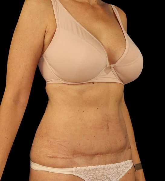Tummy Tuck Revision Before & After Patient #3157