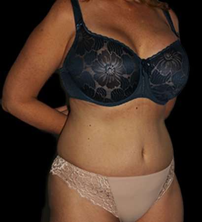 Tummy Tuck Revision Before & After Patient #3168