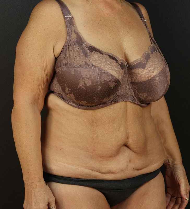 Tummy Tuck Revision Before & After Patient #3181