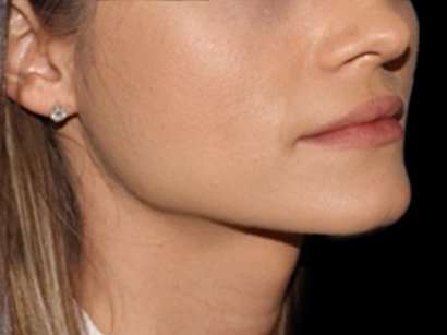 Lip Augmentation - Fat Grafting Before & After Patient #3210