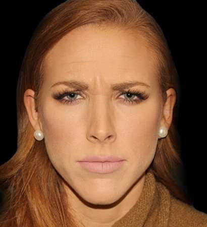 Botox Before & After Patient #3217