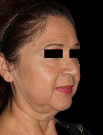 Face & Neck Lift Before & After Patient #3248