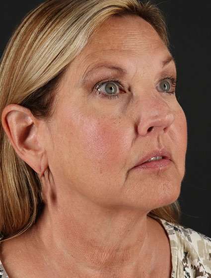 Face & Neck Lift Before & After Patient #3259