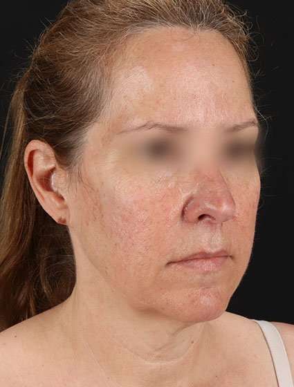 Face & Neck Lift Before & After Patient #3270