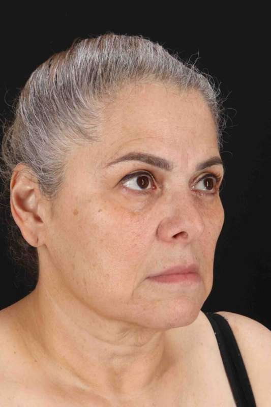 Face & Neck Lift Before & After Patient #3292
