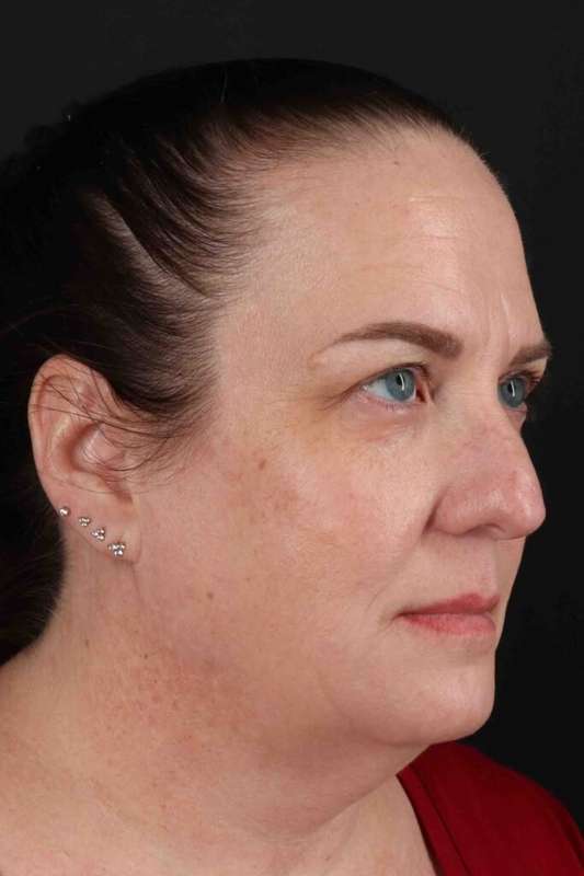Face & Neck Lift Before & After Patient #3303