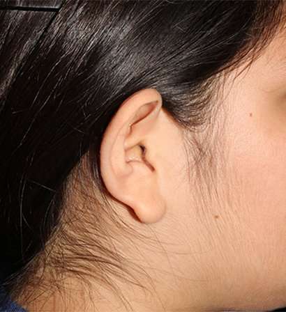 Otoplasty Before & After Patient #3319