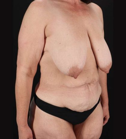 Augmentation/Lift Before & After Patient #1162