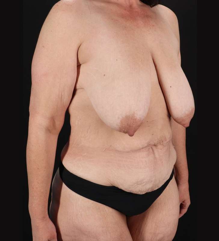 Augmentation/Lift Before & After Patient #1162