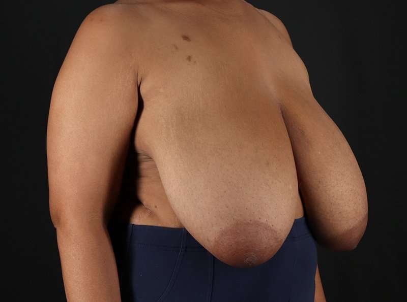 Breast Reduction Before & After Patient #1228