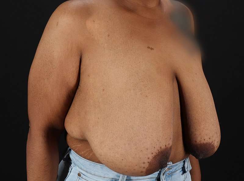 Breast Reduction Before & After Patient #1272
