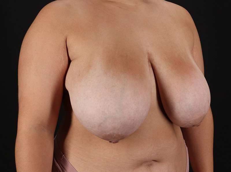 Breast Reduction Before & After Patient #1283