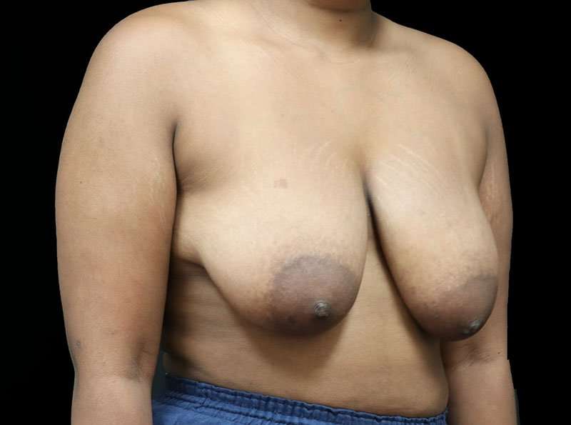 Breast Lift Before & After Patient #1343