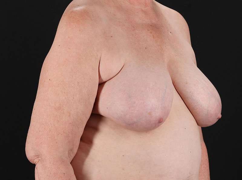 Breast Reduction Before & After Patient #1376