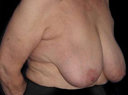 Breast Reduction Before & After Patient #1464