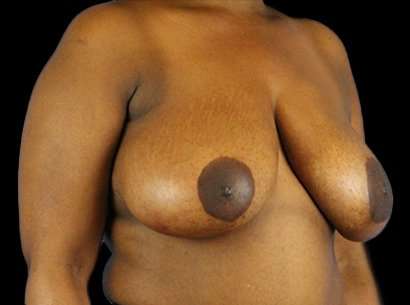 Breast Reduction Before & After Patient #1475