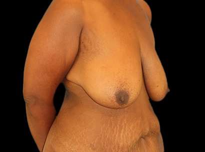 Breast Reduction Before & After Patient #1486