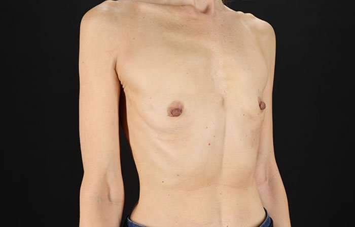 Breast Augmentation - Implant Before & After Patient #943