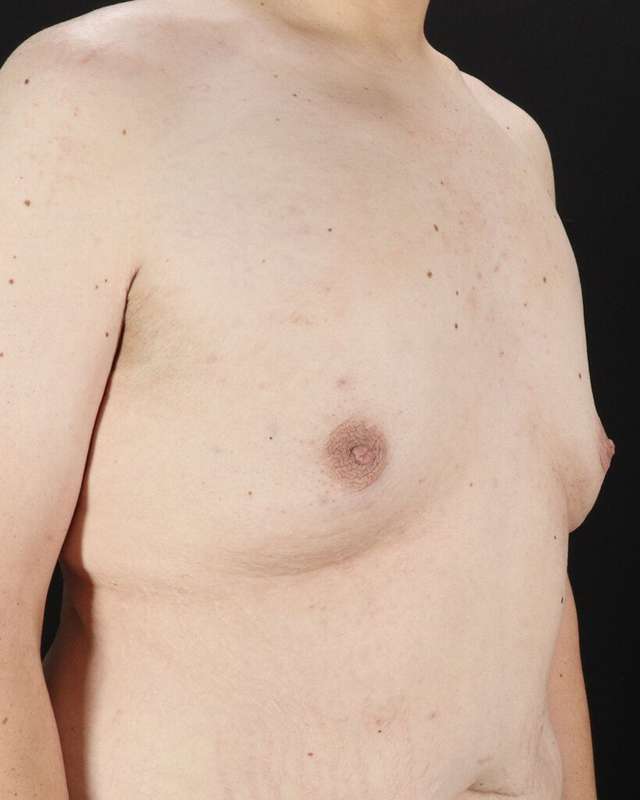 Gynecomastia Before & After Patient #1603