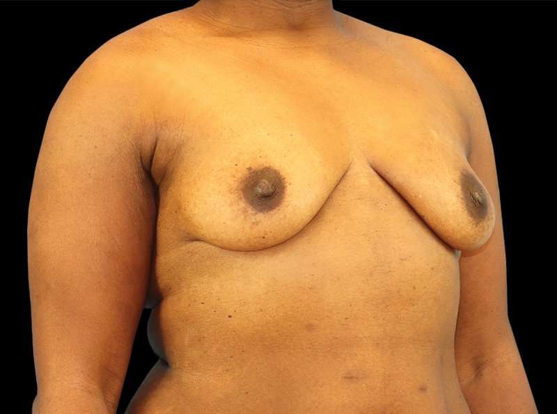Breast Augmentation - Implant Before & After Patient #954