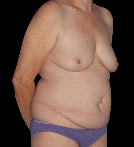 DIEP Flap Reconstruction Before & After Patient #1634