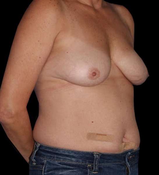 DIEP Flap Reconstruction Before & After Patient #1652