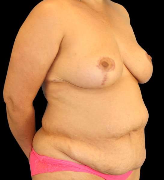 DIEP Flap Reconstruction Before & After Patient #1663
