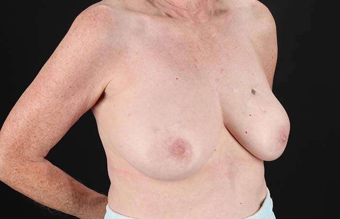 Implant Based Breast Reconstruction Before & After Patient #1718