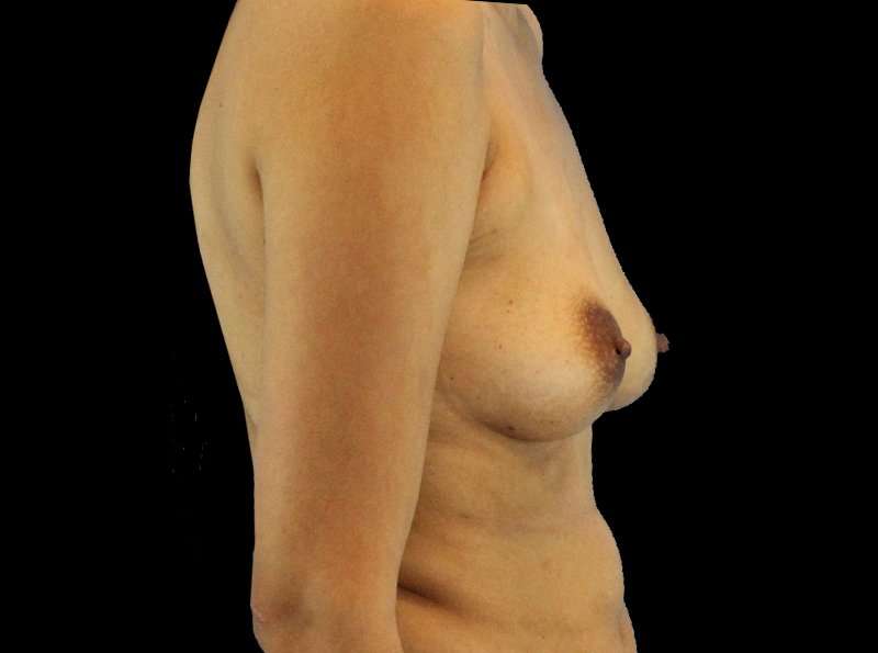 Breast Augmentation - Implant Before & After Patient #961