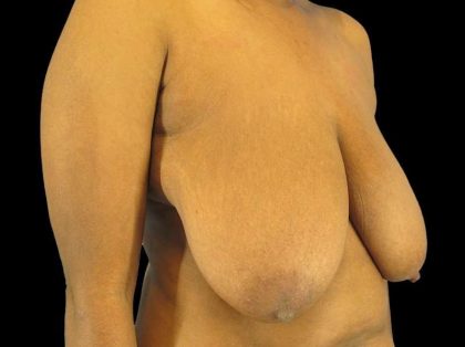 Oncoplastic Reconstruction Before & After Patient #1784