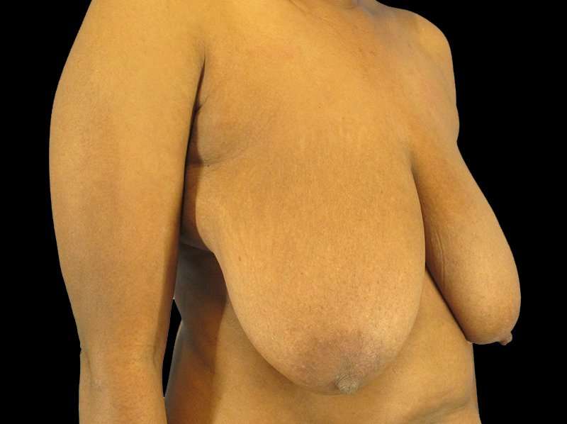 Oncoplastic Reconstruction Before & After Patient #1784