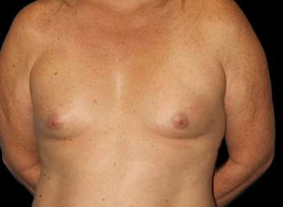 MTF Breast Augmentation Before & After Patient #1802