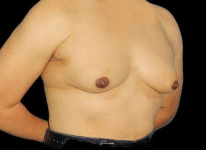 MTF Breast Augmentation Before & After Patient #1809