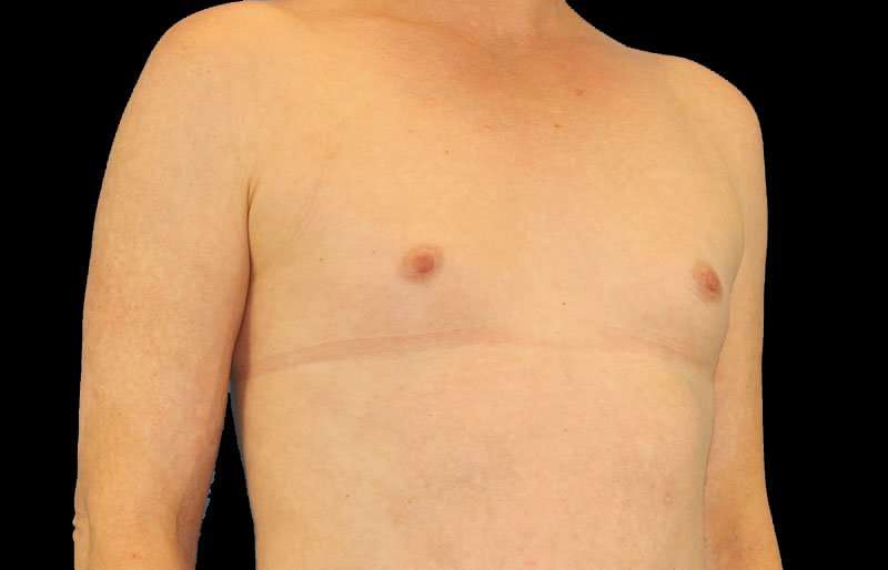 MTF Breast Augmentation Before & After Patient #1820