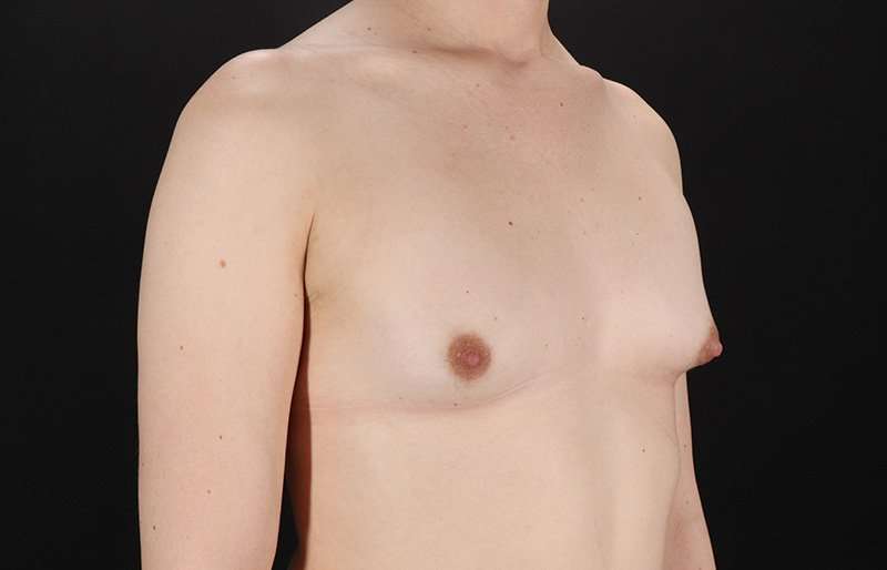 MTF Breast Augmentation Before & After Patient #1842