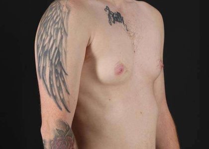FTM Chest Contouring Before & After Patient #1864