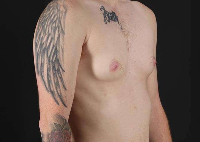 FTM Chest Contouring Before & After Patient #1864