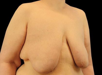 FTM Chest Contouring Before & After Patient #1875