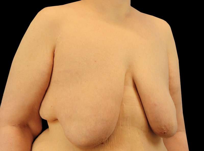 FTM Chest Contouring Before & After Patient #1875