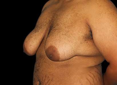 FTM Chest Contouring Before & After Patient #1893