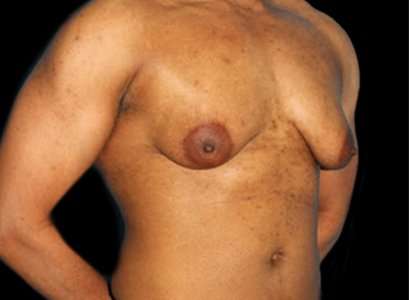 FTM Chest Contouring Before & After Patient #1907