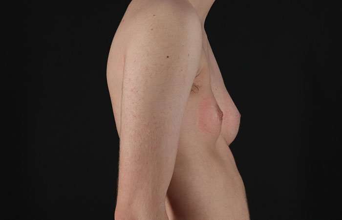 FTM Chest Contouring Before & After Patient #1940