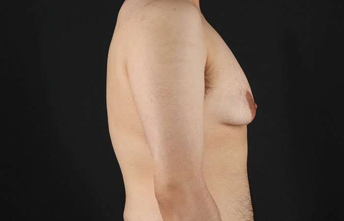 FTM Chest Contouring Before & After Patient #1951