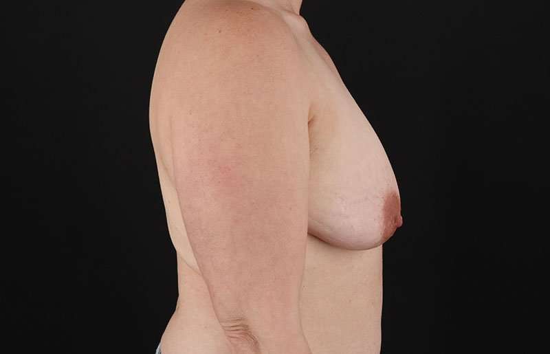 FTM Chest Contouring Before & After Patient #1973
