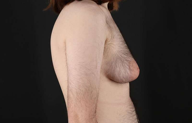 FTM Chest Contouring Before & After Patient #1984