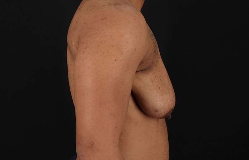 FTM Chest Contouring Before & After Patient #1995