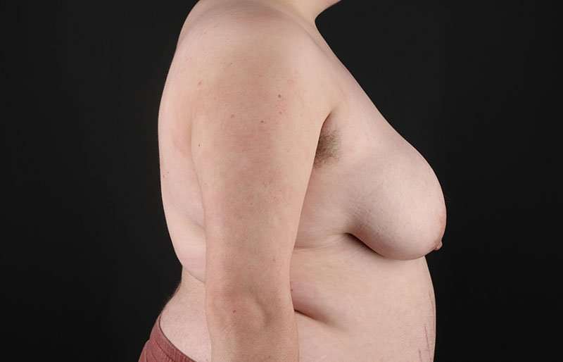 FTM Chest Contouring Before & After Patient #2006