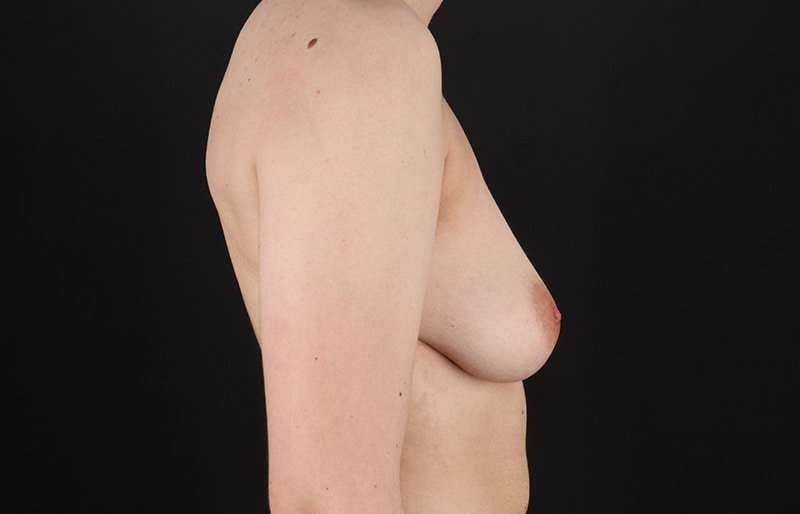 FTM Chest Contouring Before & After Patient #2017