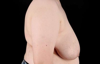 FTM Chest Contouring Before & After Patient #2039