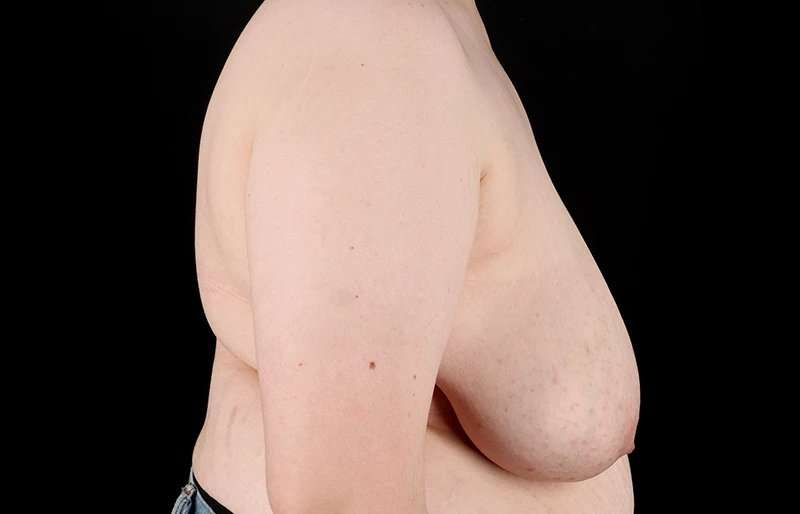 FTM Chest Contouring Before & After Patient #2039